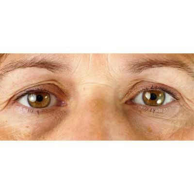 eye